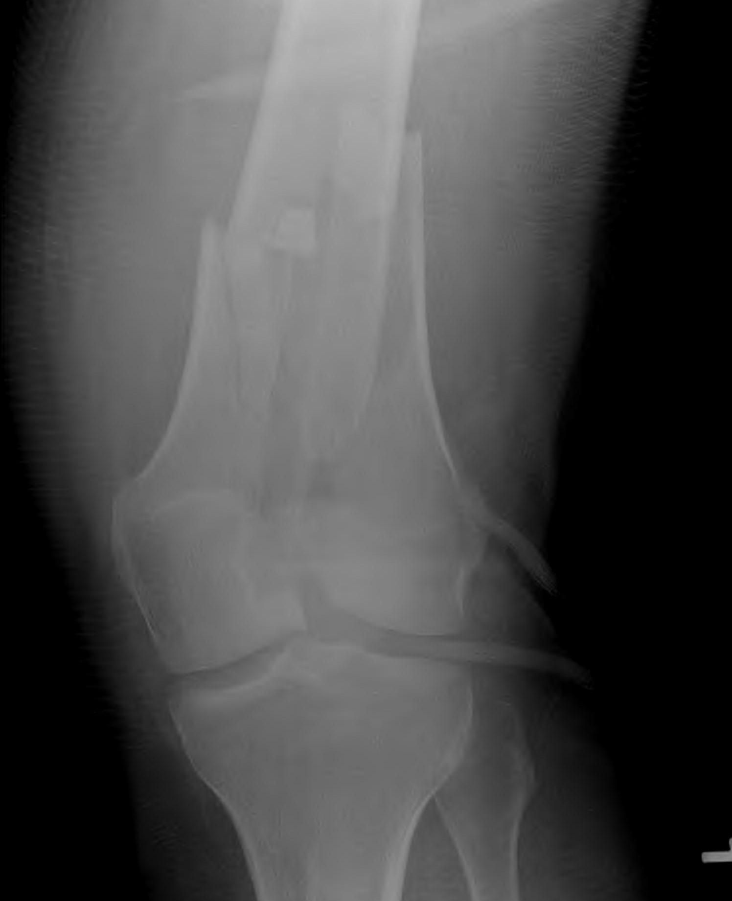 Distal Femur Fracture Intercondylar  2